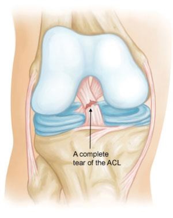 acl tear