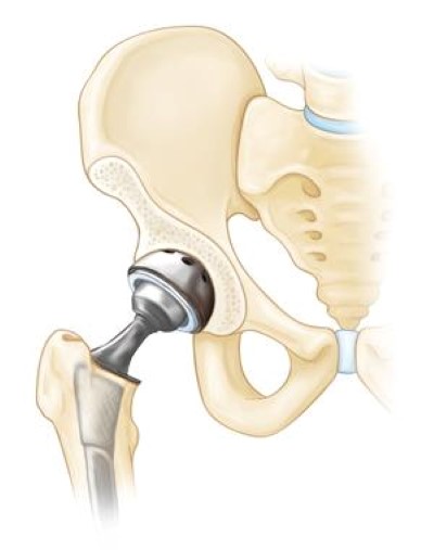 hip osteoarthritis