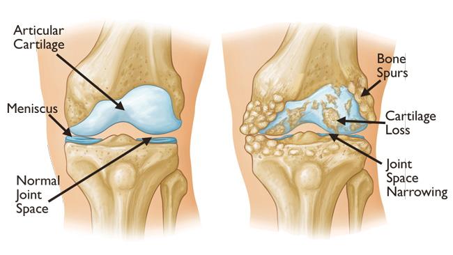 knee arthrtitis