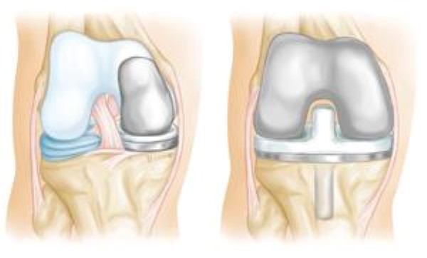 knee arthrtitis