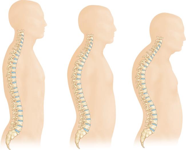 osteoporotic spine fractures