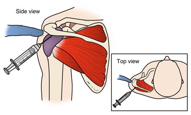 rotator cuff tear